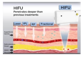 hifu layers